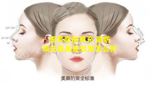 歪鼻脂肪填充 脂肪填充鼻基底效果怎么样